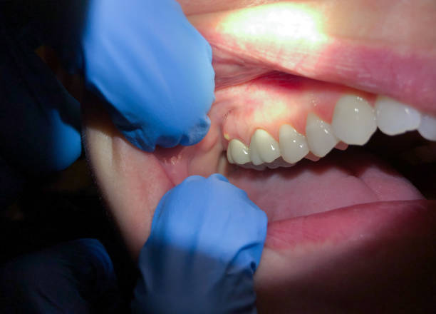 Best Emergency Tooth Extraction in Wyboo, SC